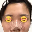 軟骨移植 フェアクリニック川口 DAY 3 サムネイル用