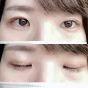 二重切開 松下皮フ形成外科 DAY 36 サムネイル用