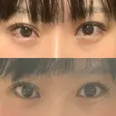 二重埋没 TCB東京中央美容外科 心斎橋筋院 AFTER サムネイル用