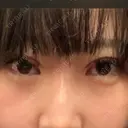 二重埋没 TCB東京中央美容外科 心斎橋筋院 DAY 0 サムネイル用