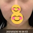 レーザートーニング（美白・肝斑） R.O.clinic AFTER サムネイル用