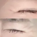 シワ取りボトックス 湘南美容クリニック 藤沢院 AFTER サムネイル用