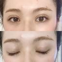 二重埋没 湘南美容クリニック 渋谷院 DAY 2 サムネイル用