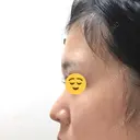 軟骨移植 フェアクリニック川口 DAY 7 サムネイル用