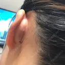 軟骨移植 フェアクリニック川口 DAY 7 サムネイル用