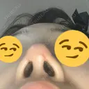 鼻尖形成（切開） / ヒアルロン酸注入（鼻） / ヒアルロン酸注入（あご） 東京ヒルズクリニック 新宿院 DAY 1 サムネイル用