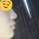 鼻尖形成（切開） / ヒアルロン酸注入（鼻） / ヒアルロン酸注入（あご） 東京ヒルズクリニック 新宿院 DAY 1 サムネイル用