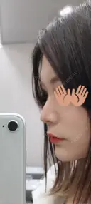 軟骨移植 フェアクリニック川口 DAY 8 サムネイル用