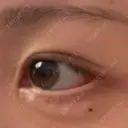 目尻切開 / タレ目形成・グラマラスライン（切開） / 目尻靭帯移動 アネシス美容クリニック DAY 16 サムネイル用