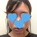 脂肪溶解注射（顔） UB CLINIC銀座 DAY 46 サムネイル用
