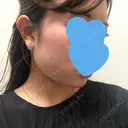 脂肪溶解注射（顔） UB CLINIC銀座 DAY 46 サムネイル用