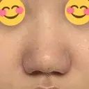 小鼻縮小（切開） / 鼻翼挙上 / 鼻孔縁挙上 くさのたろうクリニック DAY 8 サムネイル用