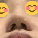 小鼻縮小（切開） / 鼻翼挙上 / 鼻孔縁挙上 くさのたろうクリニック DAY 8 サムネイル用