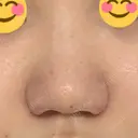 小鼻縮小（切開） / 鼻翼挙上 / 鼻孔縁挙上 くさのたろうクリニック DAY 9 サムネイル用