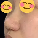 小鼻縮小（切開） / 鼻翼挙上 / 鼻孔縁挙上 くさのたろうクリニック DAY 9 サムネイル用