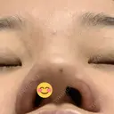 小鼻縮小（切開） / 鼻翼挙上 / 鼻孔縁挙上 くさのたろうクリニック DAY 9 サムネイル用