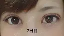 二重埋没 品川美容外科 福岡院 DAY 7 サムネイル用