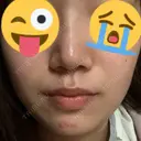 鼻尖形成（切開） / ヒアルロン酸注入（鼻） / ヒアルロン酸注入（あご） 東京ヒルズクリニック 新宿院 DAY 5 サムネイル用