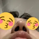 鼻尖形成（切開） / ヒアルロン酸注入（鼻） / ヒアルロン酸注入（あご） 東京ヒルズクリニック 新宿院 DAY 5 サムネイル用