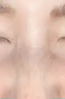 シワ取りボトックス 湘南美容クリニック 藤沢院 AFTER サムネイル用