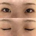二重埋没 恵聖会クリニック 京橋院 DAY 19 サムネイル用