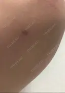 脂肪吸引（二の腕） 銀座マイアミ美容外科 DAY 20 サムネイル用