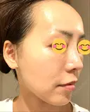 脂肪吸引（顔） / 切開リフト ドクターゴールドマンクリニック 東京高輪院 DAY 43 サムネイル用