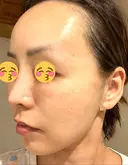 脂肪吸引（顔） / 切開リフト ドクターゴールドマンクリニック 東京高輪院 DAY 43 サムネイル用