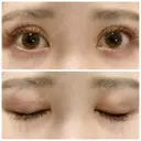 二重切開 / 上まぶたたるみ取り 城本クリニック 姫路院 DAY 84 サムネイル用