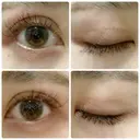 二重切開 / 上まぶたたるみ取り 城本クリニック 姫路院 DAY 84 サムネイル用