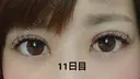 二重埋没 品川美容外科 福岡院 DAY 11 サムネイル用