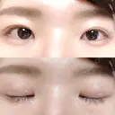 二重切開 松下皮フ形成外科 DAY 49 サムネイル用