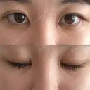 目頭切開 目白ポセンシアクリニック DAY 4 サムネイル用