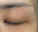 眉下切開 湘南美容クリニック 大阪京橋院 DAY 107 サムネイル用