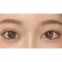 二重切開 / タレ目形成・グラマラスライン（切開） ハナキクリニック DAY 292 サムネイル用