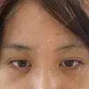 ヒアルロン酸注入（涙袋） フィラークリニック 新宿院 DAY 0 サムネイル用