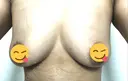 豊胸（脂肪注入） 銀座マイアミ美容外科 DAY 25 サムネイル用