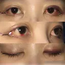 目尻切開 / 目尻靭帯移動 FROM B整形外科 (旧バウム整形外科) DAY 2 サムネイル用