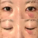 クマ治療 / 下まぶたの脂肪取り 湘南美容クリニック 赤羽院 DAY 1 サムネイル用