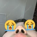 鼻尖形成（切開） / ヒアルロン酸注入（鼻） / ヒアルロン酸注入（あご） 東京ヒルズクリニック 新宿院 DAY 14 サムネイル用