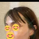 こめかみ形成 SSクリニック DAY 2 サムネイル用