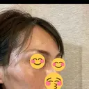こめかみ形成 SSクリニック DAY 2 サムネイル用