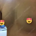豊胸（脂肪注入） 銀座マイアミ美容外科 DAY 16 サムネイル用