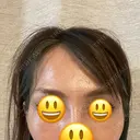 こめかみ形成 SSクリニック DAY 2 サムネイル用