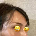 こめかみ形成 SSクリニック DAY 2 サムネイル用