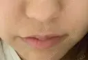 シミ取りレーザー 川崎中央クリニック AFTER サムネイル用