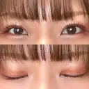 二重埋没 / 自然癒着法 シンデレラ＆ダヴィンチクリニック DAY 91 サムネイル用