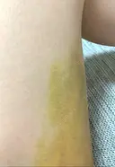 クマ治療 / 下まぶたの脂肪取り 湘南美容クリニック 赤羽院 DAY 5 サムネイル用