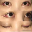 目尻切開 / 目尻靭帯移動 FROM B整形外科 (旧バウム整形外科) DAY 8 サムネイル用