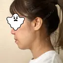 ハイフ（顔） 藤・ナチュレ美容クリニック 恵比寿院 DAY 1 サムネイル用